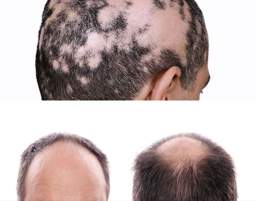 diversi tipi di alopecia